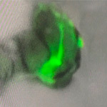 Tirotoxicòsis - malalties de la tiroide